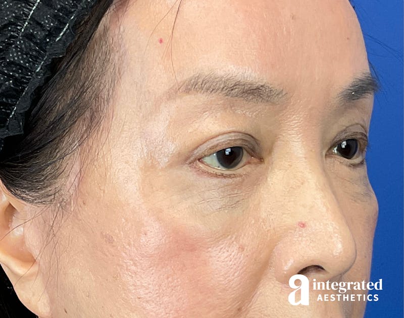 Brow Lift Before & After Gallery - Patient 354679 - Image 4
