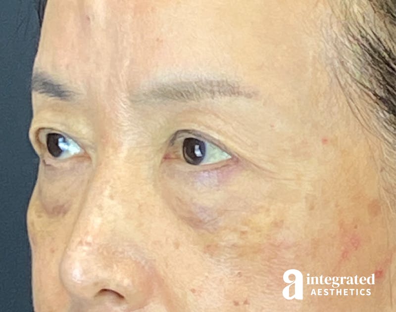 Brow Lift Before & After Gallery - Patient 354679 - Image 5
