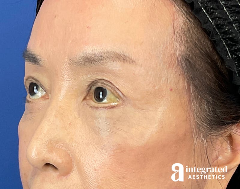 Brow Lift Before & After Gallery - Patient 354679 - Image 6