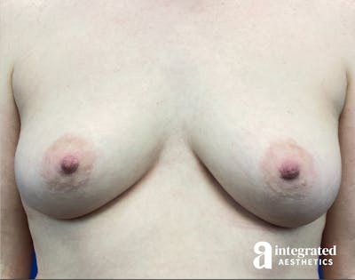 Breast Augmentation Before & After Gallery - Patient 791528 - Image 1
