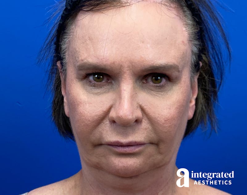 FaceTite & AccuTite Before & After Gallery - Patient 325072 - Image 1