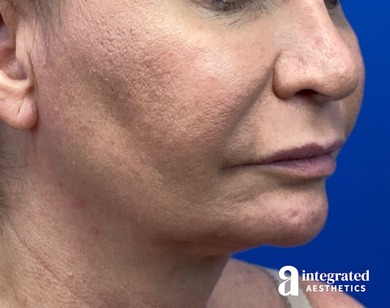 FaceTite & AccuTite Before & After Gallery - Patient 325072 - Image 3