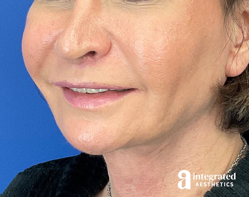FaceTite & AccuTite Before & After Gallery - Patient 325072 - Image 6