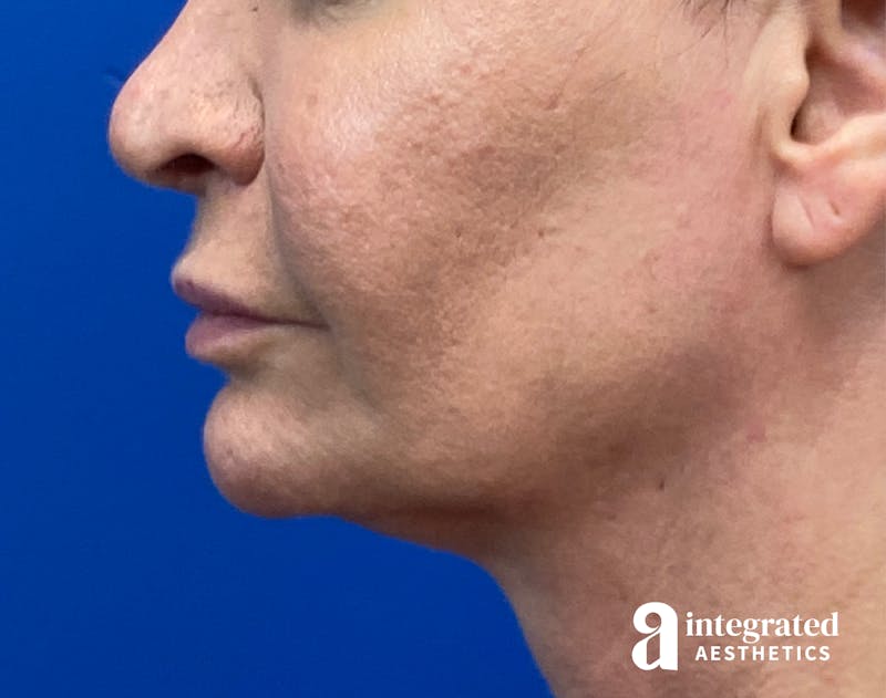 FaceTite & AccuTite Before & After Gallery - Patient 325072 - Image 9