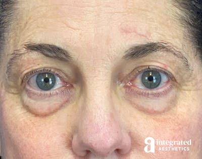 Blepharoplasty Before & After Gallery - Patient 272173 - Image 1