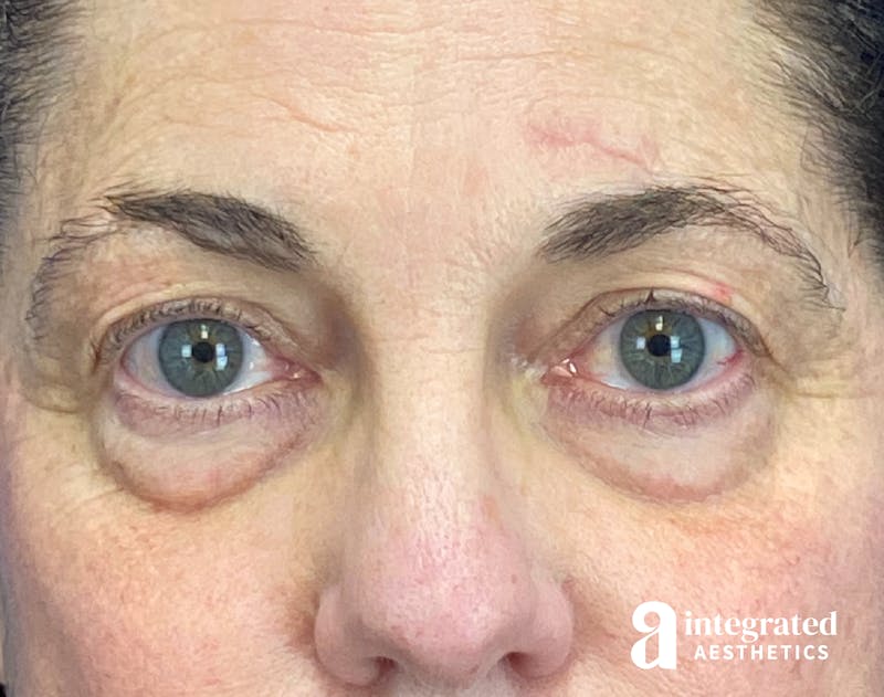 Blepharoplasty Before & After Gallery - Patient 272173 - Image 1