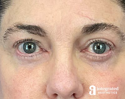 Blepharoplasty Before & After Gallery - Patient 272173 - Image 2