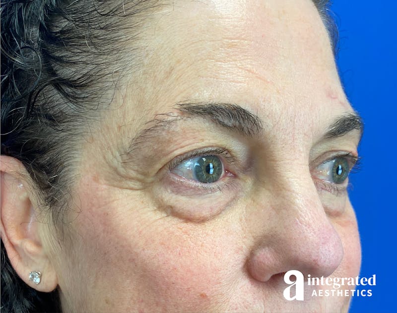 Blepharoplasty Before & After Gallery - Patient 272173 - Image 3