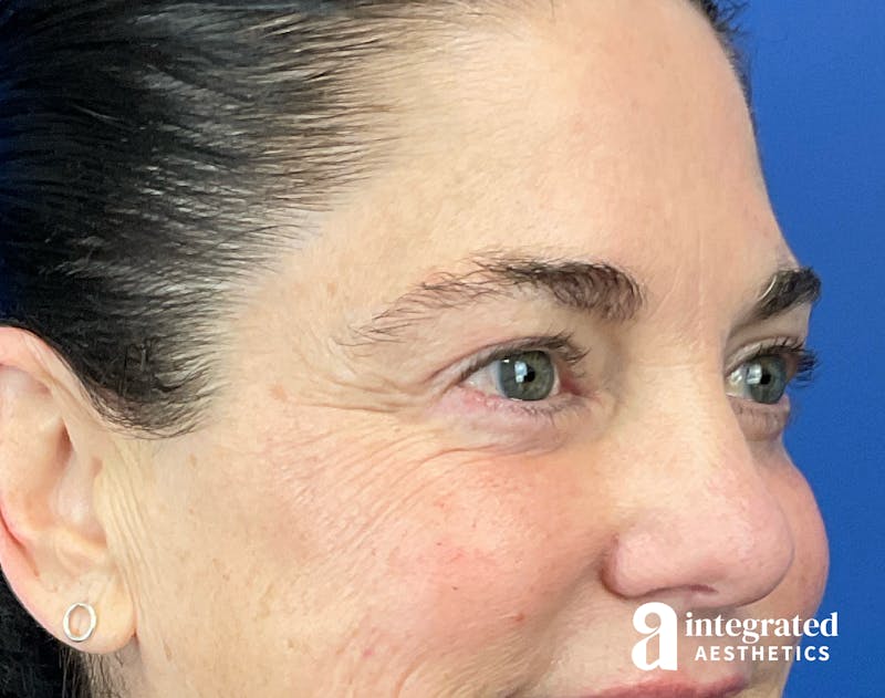 Blepharoplasty Before & After Gallery - Patient 272173 - Image 4