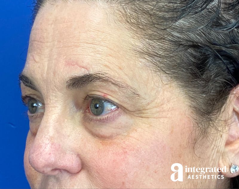Blepharoplasty Before & After Gallery - Patient 272173 - Image 5