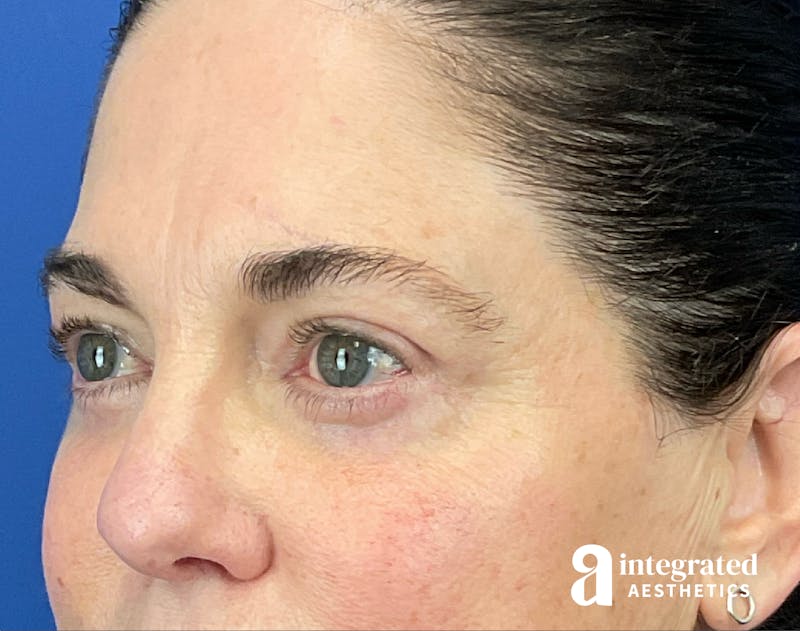 Blepharoplasty Before & After Gallery - Patient 272173 - Image 6