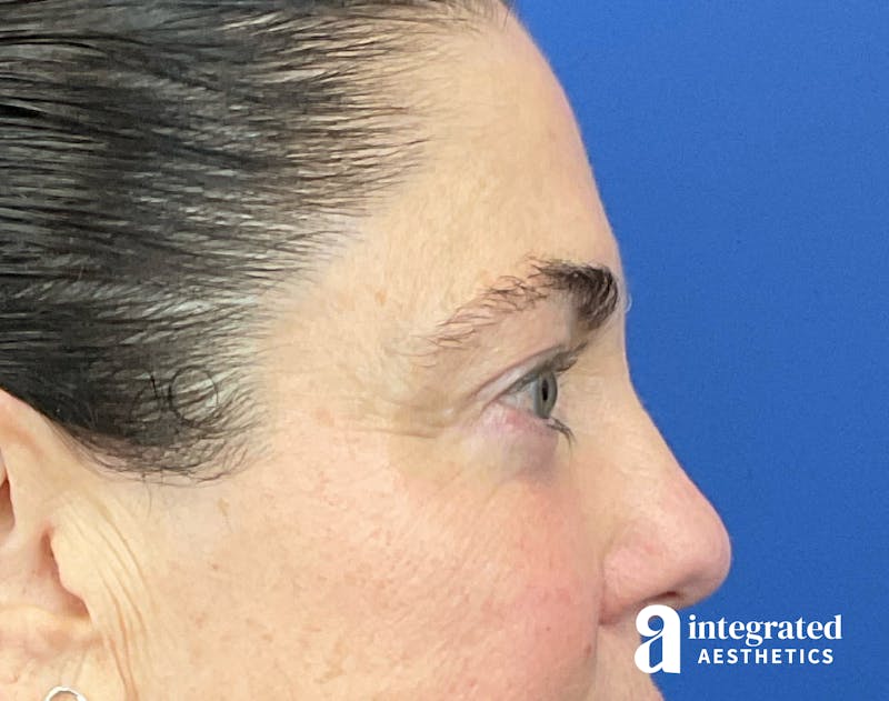 Blepharoplasty Before & After Gallery - Patient 272173 - Image 8