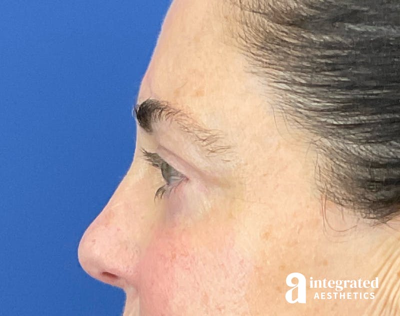 Blepharoplasty Before & After Gallery - Patient 272173 - Image 10