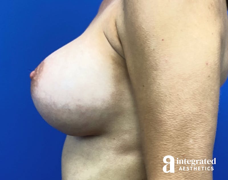 Breast Augmentation Before & After Gallery - Patient 364732 - Image 10