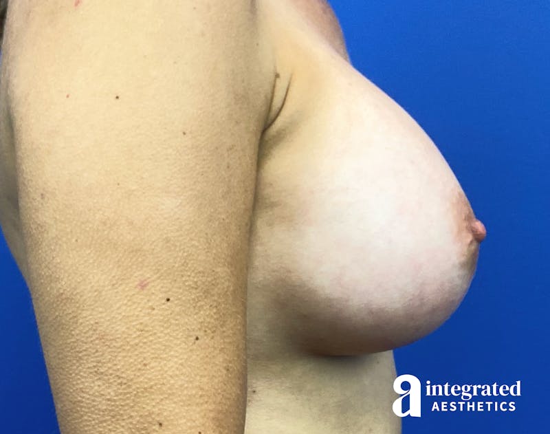 Breast Augmentation Before & After Gallery - Patient 364732 - Image 8