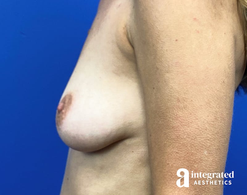 Breast Augmentation Before & After Gallery - Patient 364732 - Image 9
