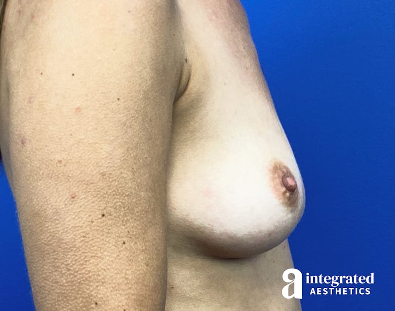 Breast Augmentation Before & After Gallery - Patient 364732 - Image 7