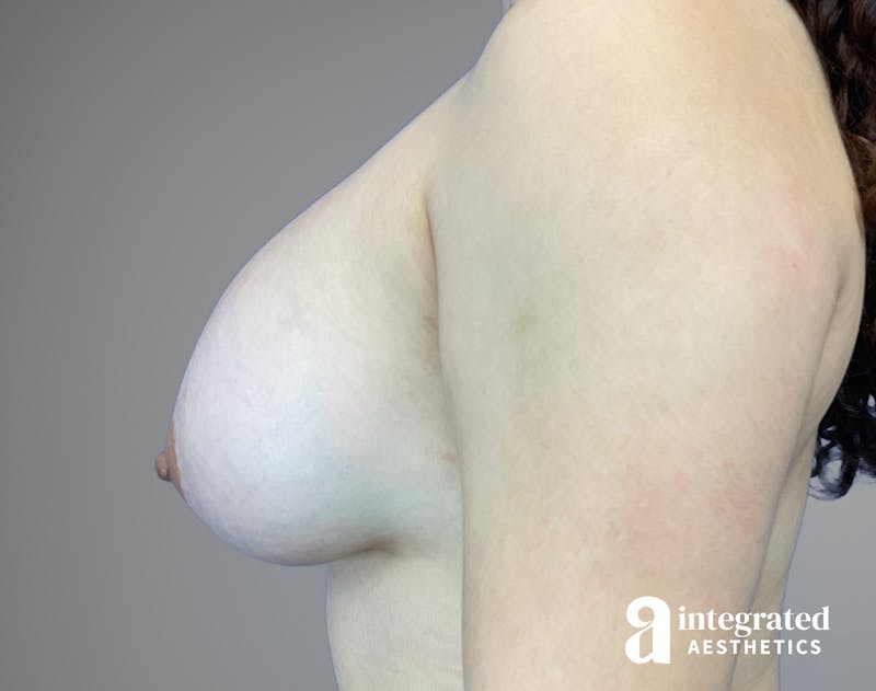 Breast Augmentation Before & After Gallery - Patient 163680 - Image 10