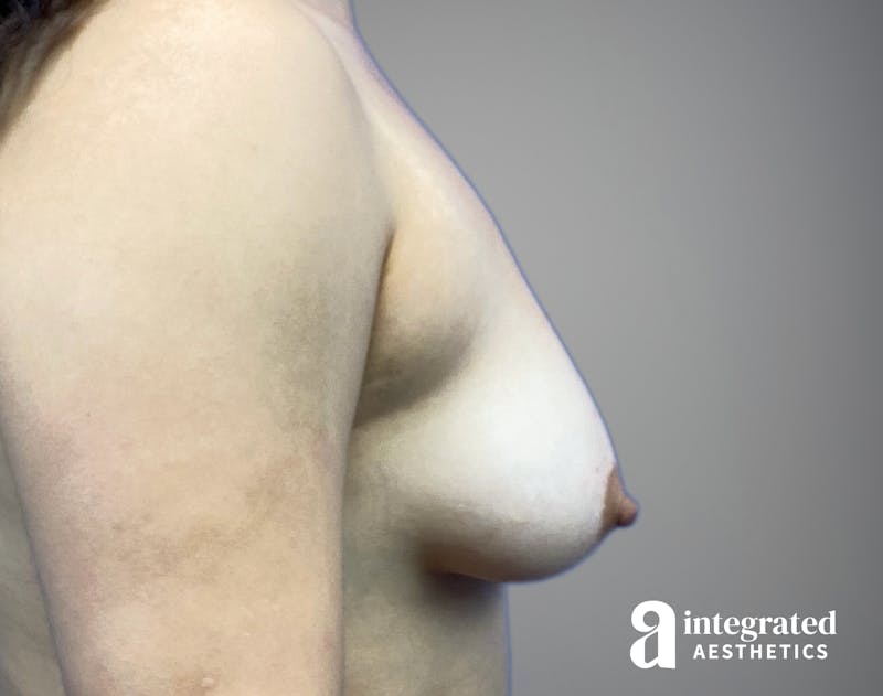 Breast Augmentation Before & After Gallery - Patient 163680 - Image 7
