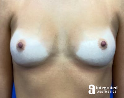 Breast Augmentation Before & After Gallery - Patient 902409 - Image 1