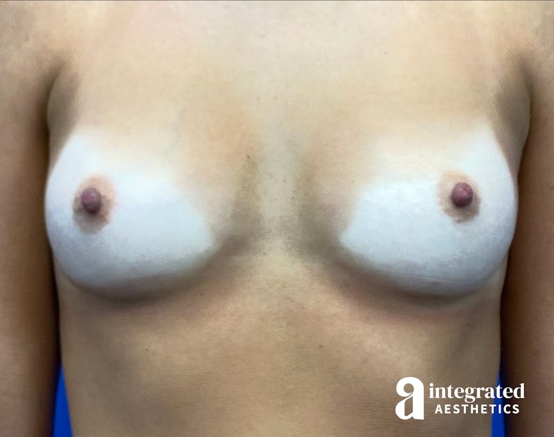 Breast Augmentation Before & After Gallery - Patient 902409 - Image 1