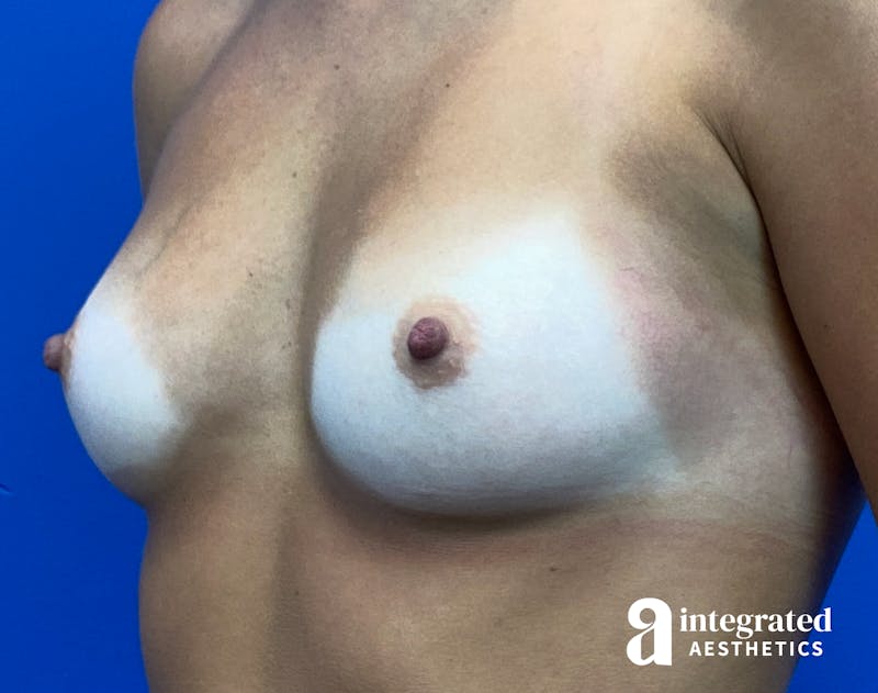Breast Augmentation Before & After Gallery - Patient 902409 - Image 5