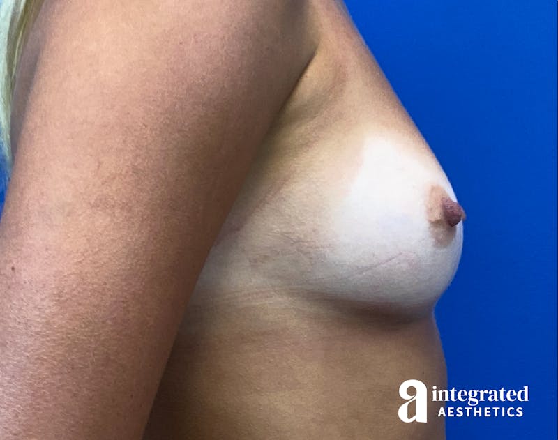 Breast Augmentation Before & After Gallery - Patient 902409 - Image 7