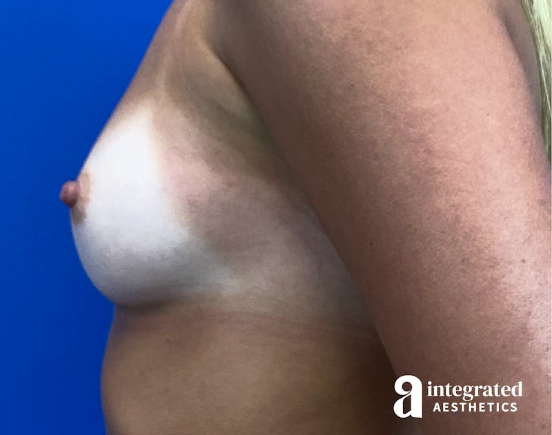 Breast Augmentation Before & After Gallery - Patient 902409 - Image 9