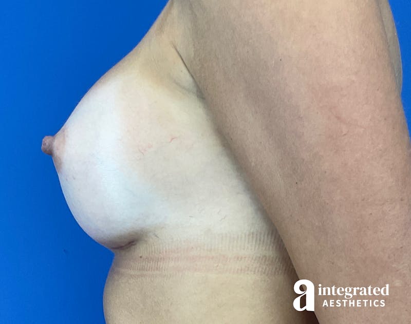 Breast Augmentation Before & After Gallery - Patient 902409 - Image 10