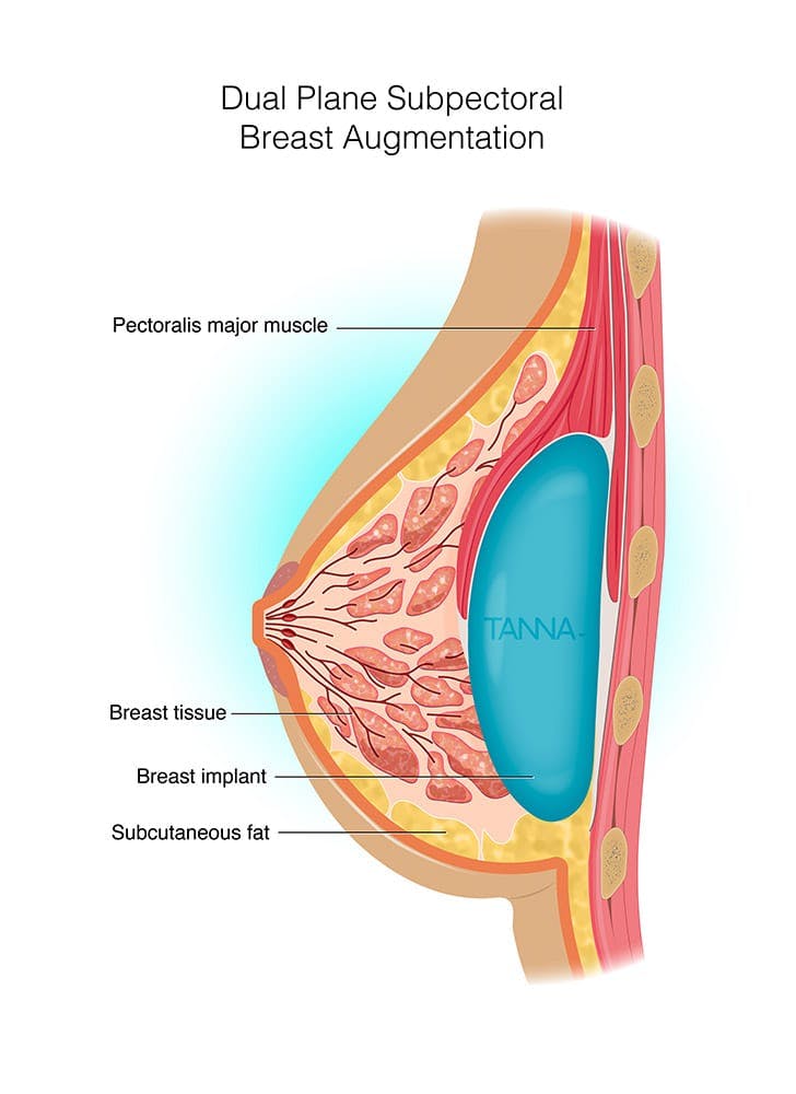 Diagram of dual plane subpectoral breast augmentation