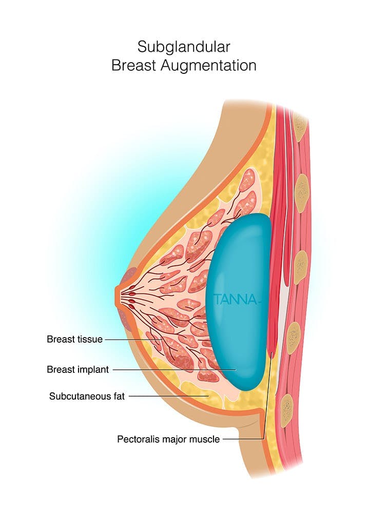 Diagram of dual plane subglandular breast augmentation
