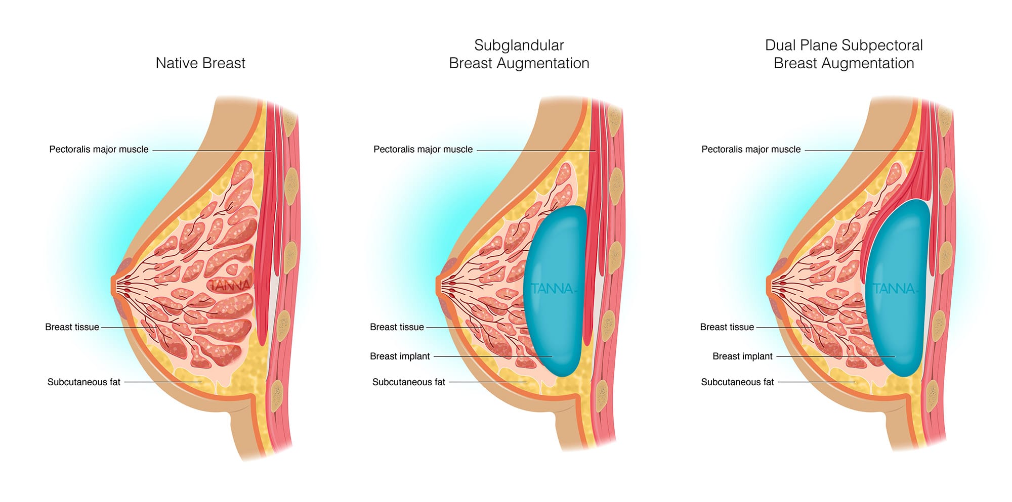Comparison of natural breast with subglandular and dual plane pectoral breast augmentations