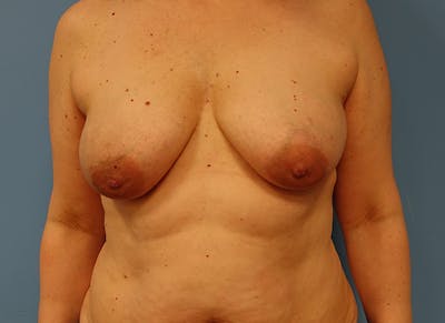 Implant Reconstruction Before & After Gallery - Patient 112334692 - Image 5