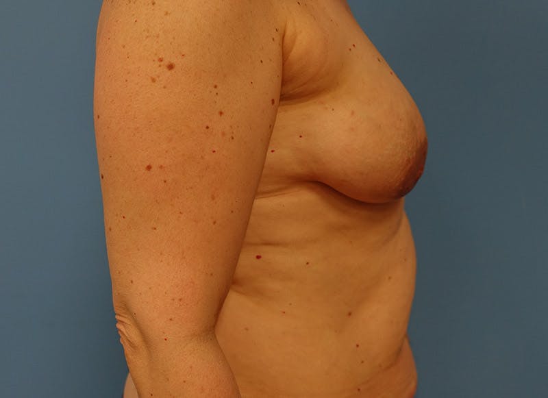 Implant Reconstruction Before & After Gallery - Patient 112334692 - Image 9