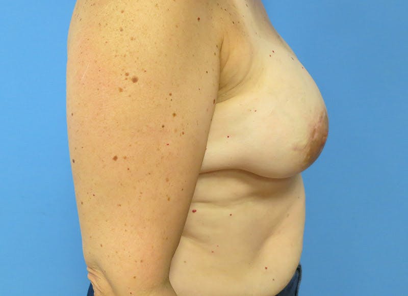 Implant Reconstruction Gallery Before & After Gallery - Patient 112334692 - Image 10