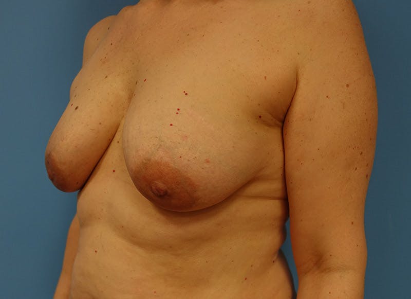 Implant Reconstruction Before & After Gallery - Patient 112334692 - Image 3