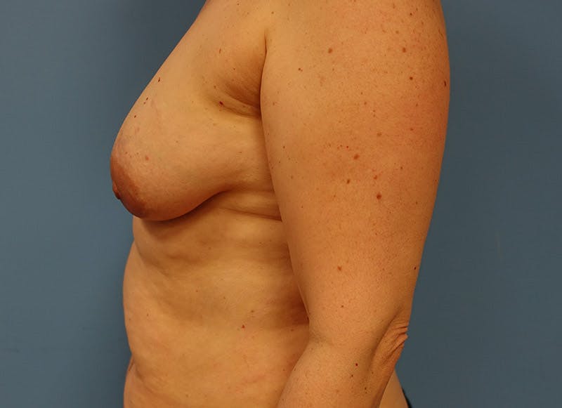 Implant Reconstruction Before & After Gallery - Patient 112334692 - Image 1
