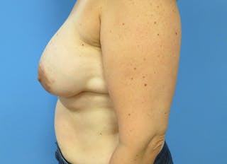 Implant Reconstruction Gallery Before & After Gallery - Patient 112334692 - Image 2