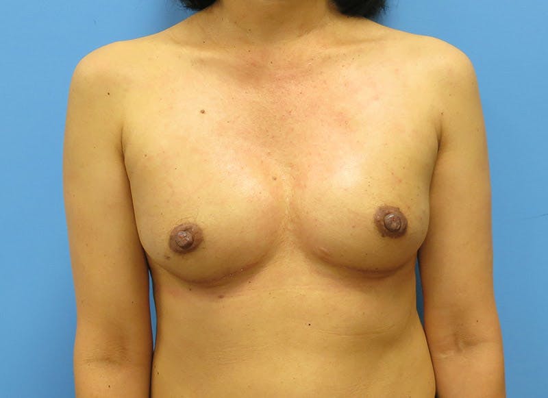 Implant Reconstruction Gallery Before & After Gallery - Patient 112334694 - Image 6