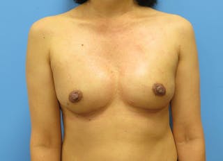 Implant Reconstruction Gallery Before & After Gallery - Patient 112334694 - Image 6