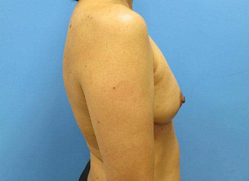 Implant Reconstruction Gallery Before & After Gallery - Patient 112334694 - Image 10