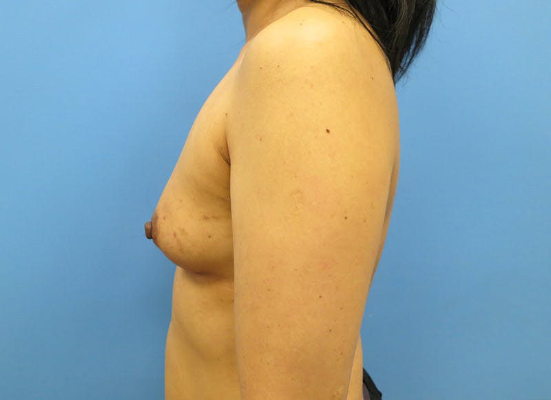Implant Reconstruction Gallery Before & After Gallery - Patient 112334694 - Image 1