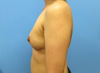 Implant Reconstruction Gallery Before & After Gallery - Patient 112334694 - Image 2