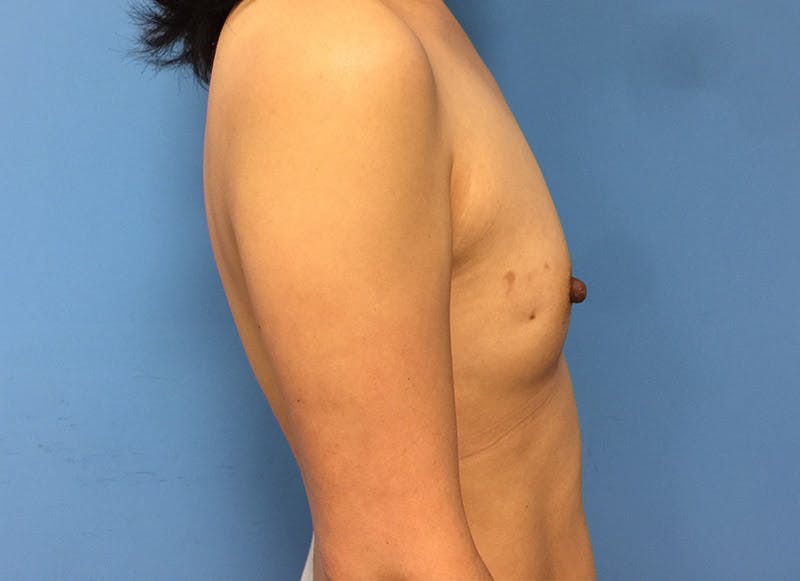 Implant Reconstruction Gallery Before & After Gallery - Patient 112337886 - Image 9