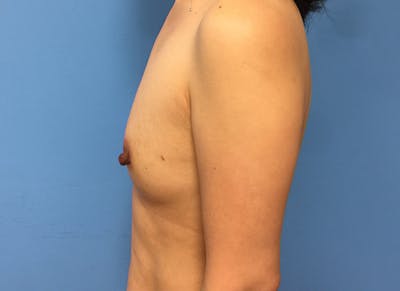 Implant Reconstruction Gallery Before & After Gallery - Patient 112337886 - Image 1