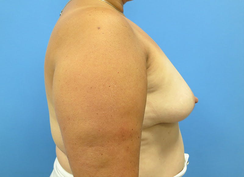 Implant Reconstruction Gallery Before & After Gallery - Patient 112337887 - Image 9