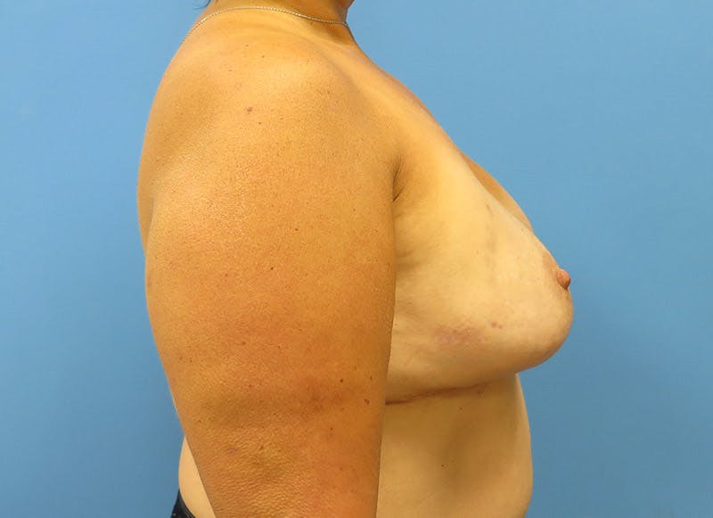 Implant Reconstruction Gallery Before & After Gallery - Patient 112337887 - Image 10
