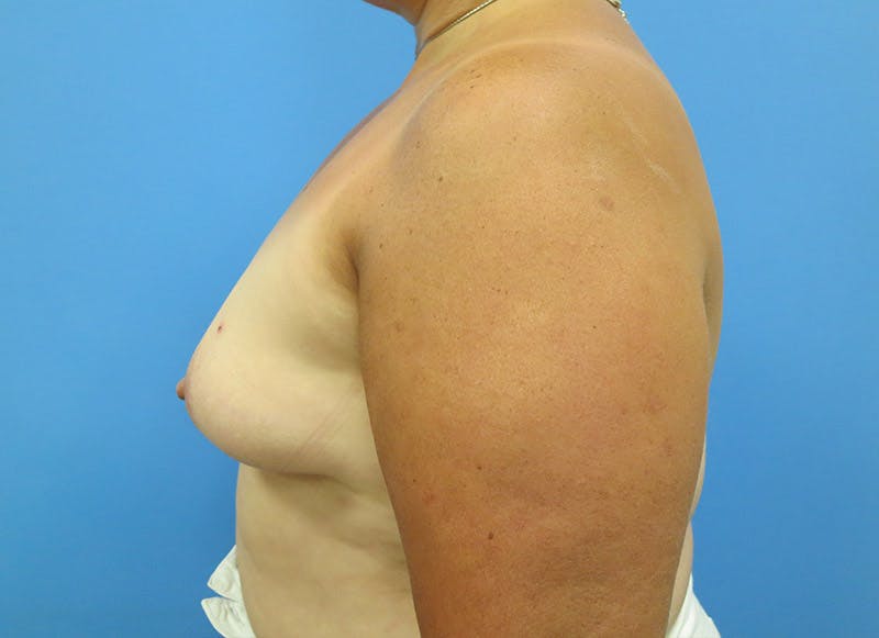 Implant Reconstruction Before & After Gallery - Patient 112337887 - Image 1