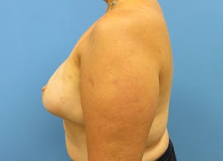 Implant Reconstruction Gallery Before & After Gallery - Patient 112337887 - Image 2