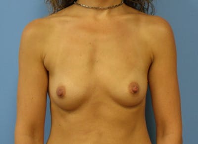 Implant Reconstruction Gallery Before & After Gallery - Patient 112337888 - Image 5